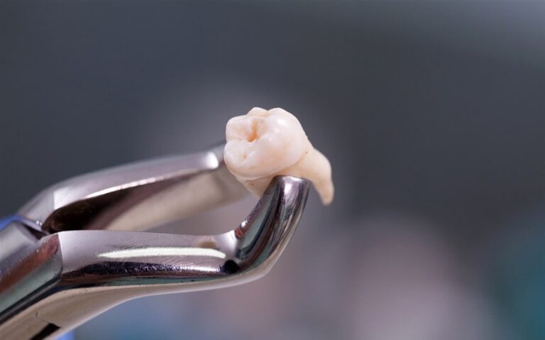 Can I Travel After Wisdom Tooth Extraction? Here’s What I Learned
